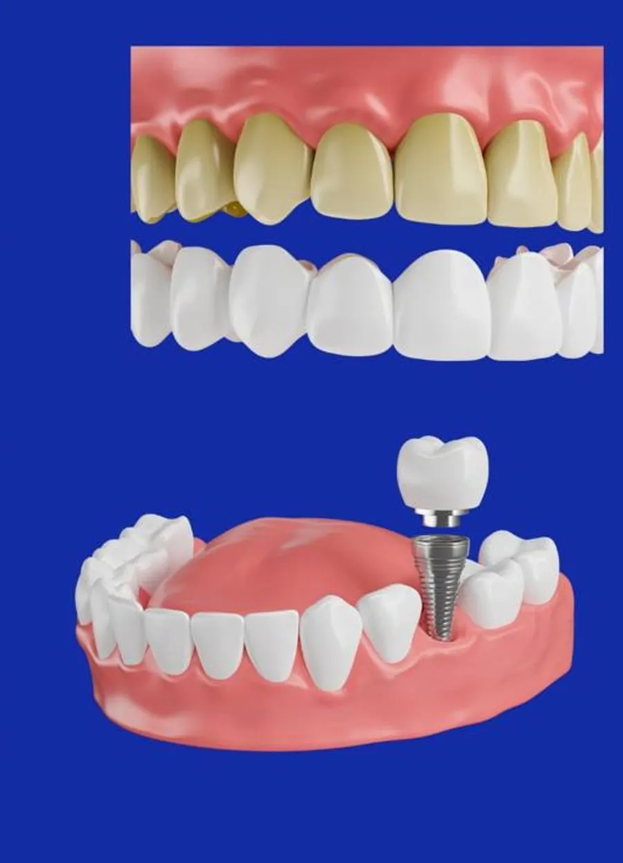Modelos 3D de rehabilitación oral: comparación antes y después y una prótesis sobre implante dental.